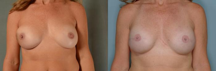 Before & After Breast Reconstruction Case 649 Front View in Tallahassee, FL