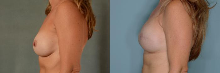 Before & After Breast Reconstruction Case 649 Left Side View in Tallahassee, FL