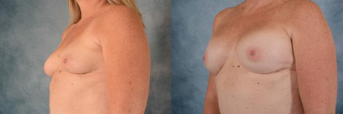 Before & After Breast Reconstruction Case 655 Left Oblique View in Tallahassee, FL