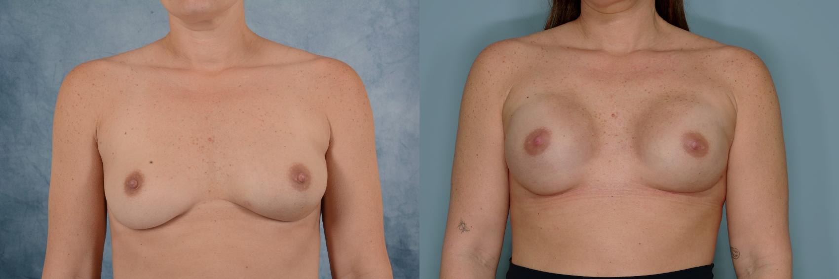 Before & After Breast Reconstruction Case 668 Front View in Tallahassee, FL
