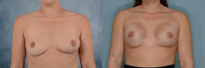 Before & After Breast Reconstruction Case 668 Front View in Tallahassee, FL