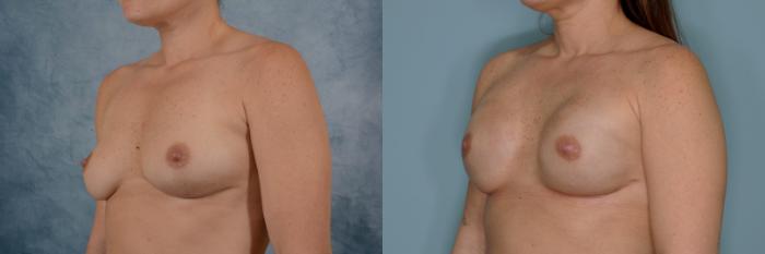 Before & After Breast Reconstruction Case 668 Left Oblique View in Tallahassee, FL