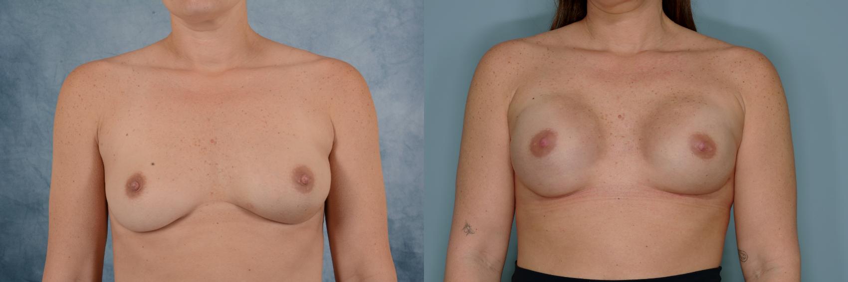 Before & After Breast Reconstruction Case 718 Front View in Tallahassee, FL