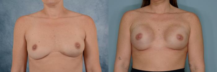 Before & After Breast Reconstruction Case 718 Front View in Tallahassee, FL