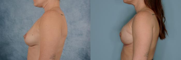 Before & After Breast Reconstruction Case 718 Left Side View in Tallahassee, FL
