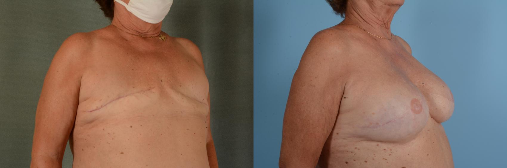 Before & After Breast Reconstruction Case 723 Right Oblique View in Tallahassee, FL