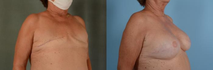 Before & After Breast Reconstruction Case 723 Right Oblique View in Tallahassee, FL