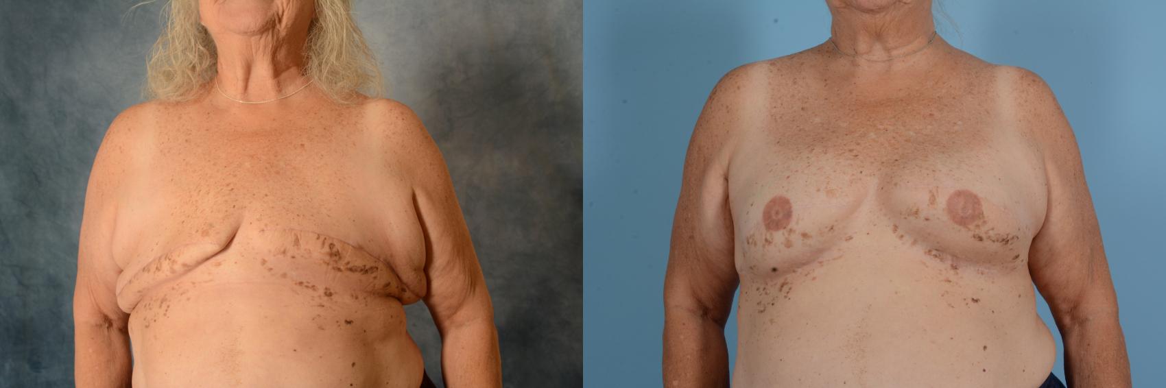 Before & After Breast Reconstruction Case 749 Front View in Tallahassee, FL