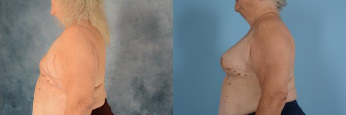 Before & After Breast Reconstruction Case 749 Left Side View in Tallahassee, FL