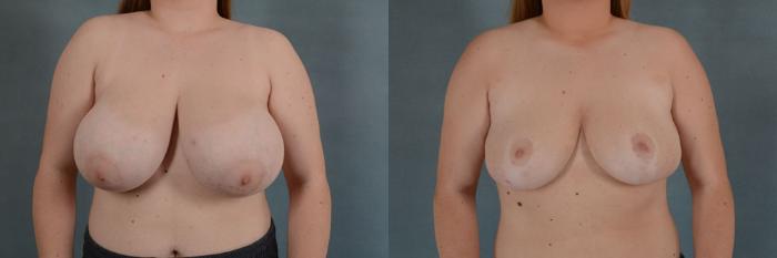 Before & After Breast Reduction Case 162 View #1 View in Tallahassee, FL