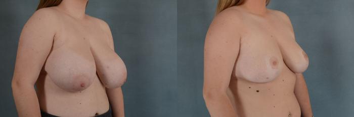 Before & After Breast Reduction Case 162 View #2 View in Tallahassee, FL
