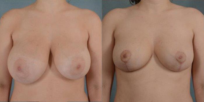 Before & After Breast Reduction Case 163 View #1 View in Tallahassee, FL