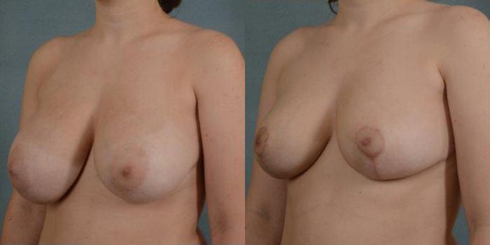 Before & After Breast Reduction Case 163 View #2 View in Tallahassee, FL