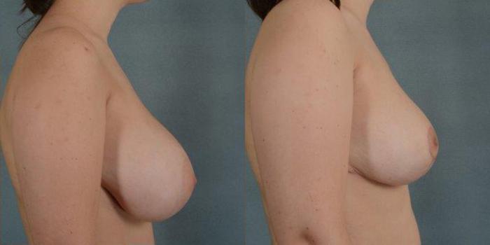 Before & After Breast Reduction Case 163 View #3 View in Tallahassee, FL