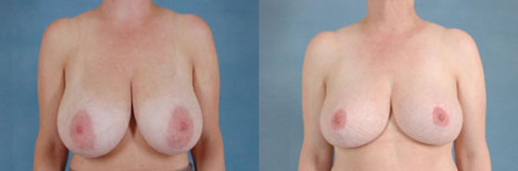 Before & After Breast Reduction Case 164 View #1 View in Tallahassee, FL
