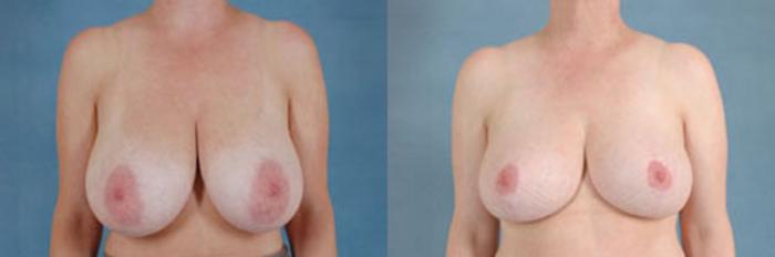 Before & After Breast Reduction Case 164 View #1 View in Tallahassee, FL