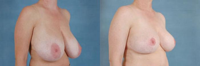 Before & After Breast Reduction Case 164 View #2 View in Tallahassee, FL