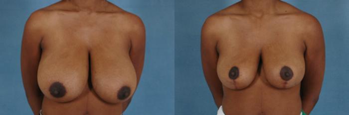 Before & After Breast Reduction Case 165 View #1 View in Tallahassee, FL
