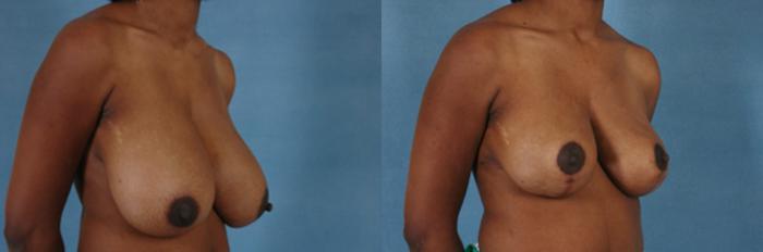 Before & After Breast Reduction Case 165 View #2 View in Tallahassee, FL