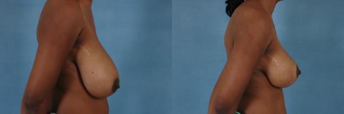 Before & After Breast Reduction Case 165 View #3 View in Tallahassee, FL