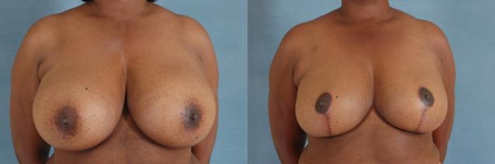 Before & After Breast Reduction Case 166 View #1 View in Tallahassee, FL