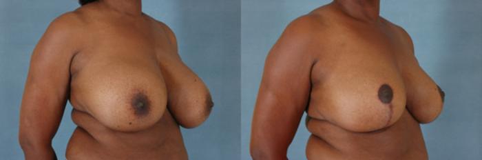 Before & After Breast Reduction Case 166 View #2 View in Tallahassee, FL