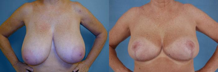 Before & After Breast Reduction Case 167 View #1 View in Tallahassee, FL