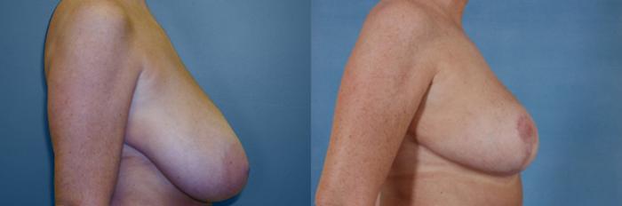 Before & After Breast Reduction Case 167 View #2 View in Tallahassee, FL