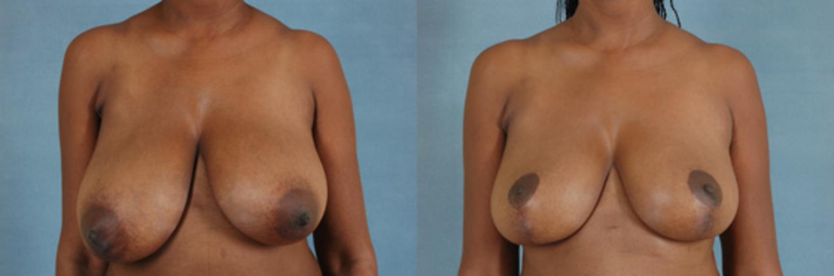 Before & After Breast Reduction Case 168 View #1 View in Tallahassee, FL