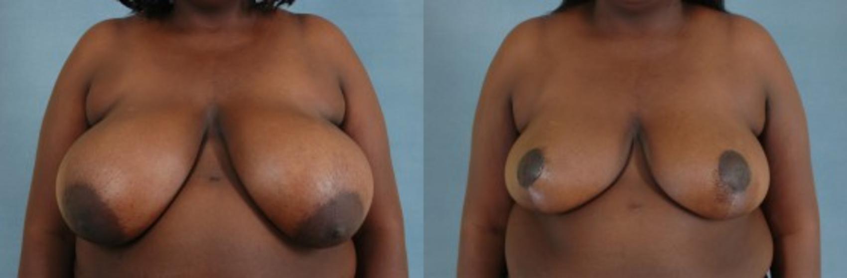 Before & After Breast Reduction Case 169 View #1 View in Tallahassee, FL