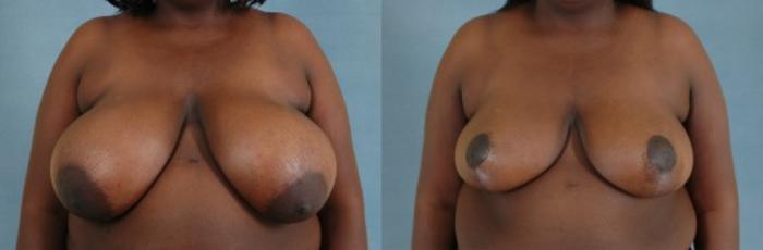 Before & After Breast Reduction Case 169 View #1 View in Tallahassee, FL