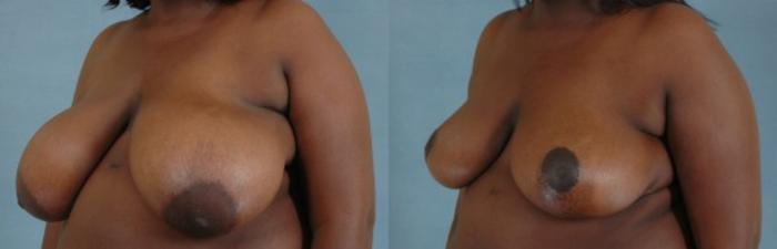 Before & After Breast Reduction Case 169 View #2 View in Tallahassee, FL