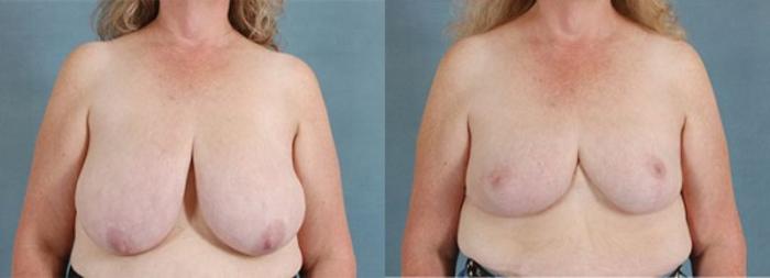 Before & After Breast Reduction Case 170 View #1 View in Tallahassee, FL