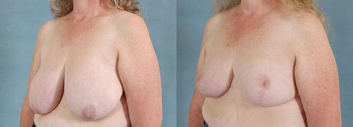 Before & After Breast Reduction Case 170 View #2 View in Tallahassee, FL