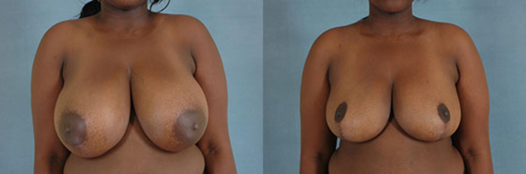 Before & After Breast Reduction Case 171 View #1 View in Tallahassee, FL