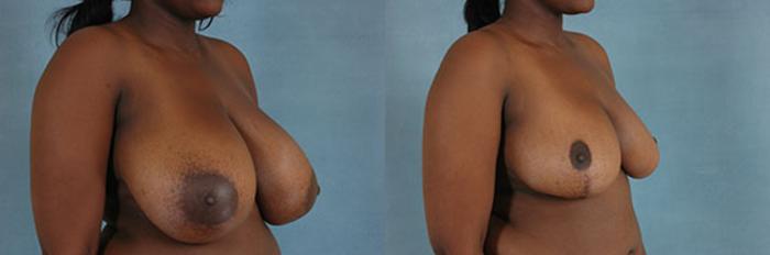 Before & After Breast Reduction Case 171 View #2 View in Tallahassee, FL