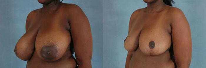 Before & After Breast Reduction Case 171 View #3 View in Tallahassee, FL