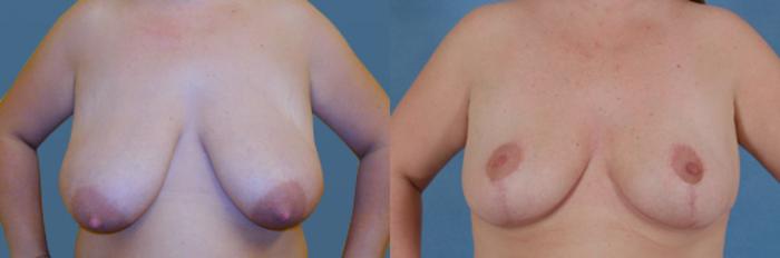 Before & After Breast Reduction Case 172 View #1 View in Tallahassee, FL