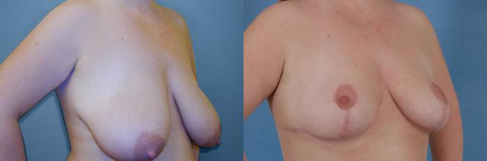 Before & After Breast Reduction Case 172 View #2 View in Tallahassee, FL