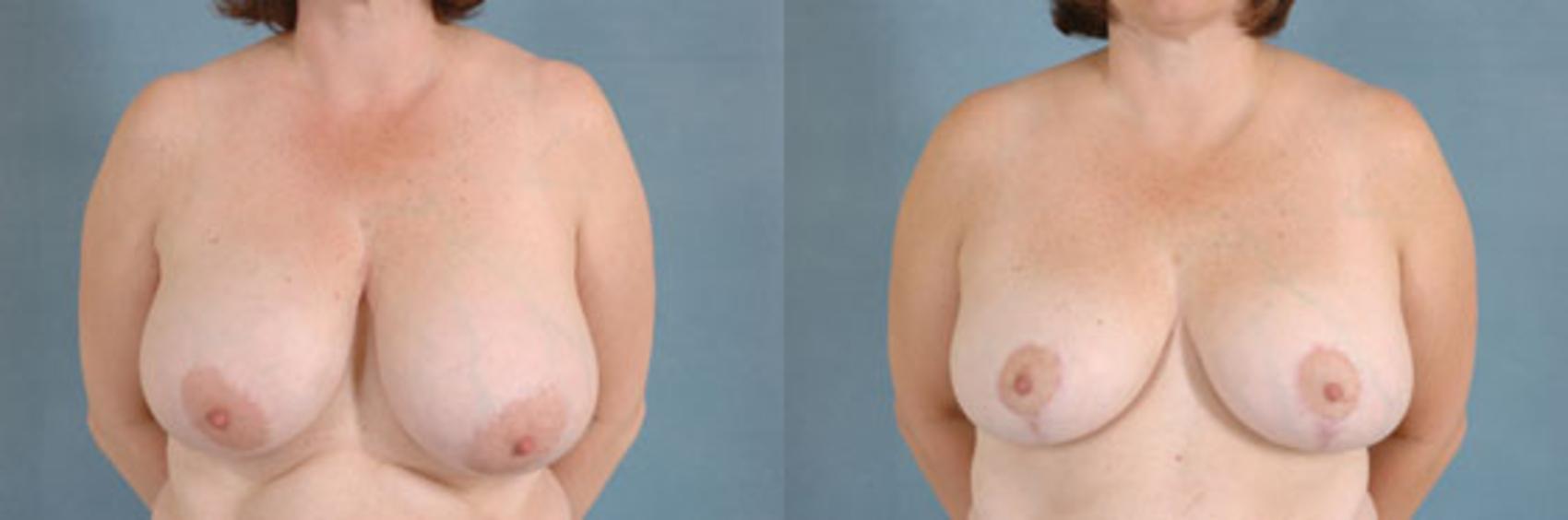 Before & After Breast Reduction Case 173 View #1 View in Tallahassee, FL