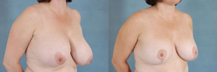 Before & After Breast Reduction Case 173 View #2 View in Tallahassee, FL