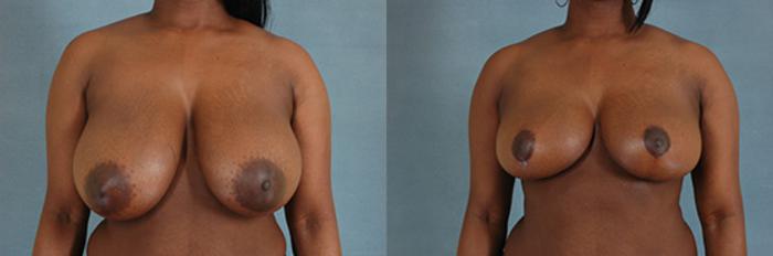 Before & After Breast Reduction Case 174 View #1 View in Tallahassee, FL