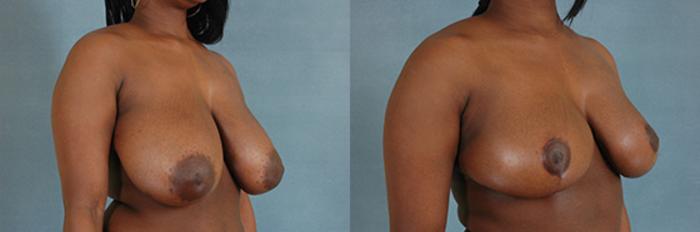 Before & After Breast Reduction Case 174 View #2 View in Tallahassee, FL