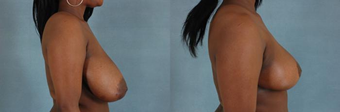 Before & After Breast Reduction Case 174 View #3 View in Tallahassee, FL