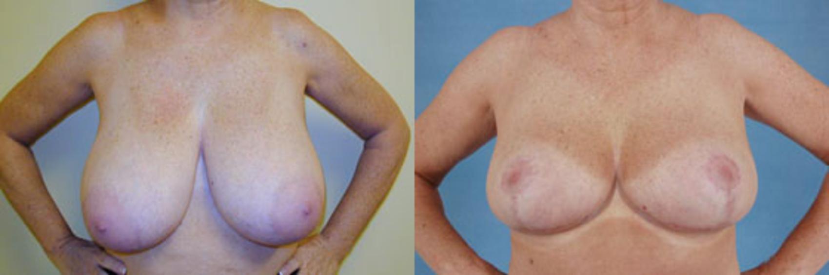 Before & After Breast Reduction Case 176 View #1 View in Tallahassee, FL