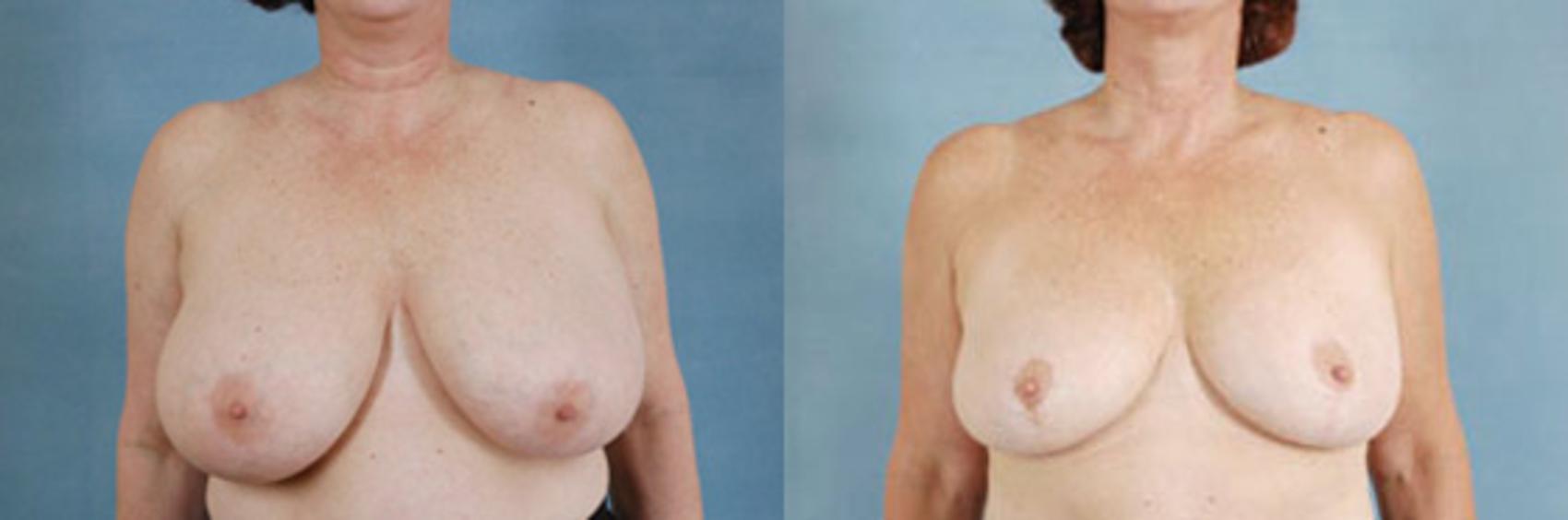 Before & After Breast Reduction Case 177 View #1 View in Tallahassee, FL