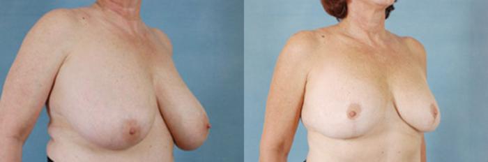 Before & After Breast Reduction Case 177 View #2 View in Tallahassee, FL