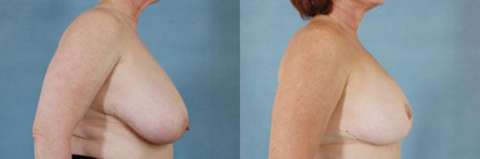 Before & After Breast Reduction Case 177 View #3 View in Tallahassee, FL