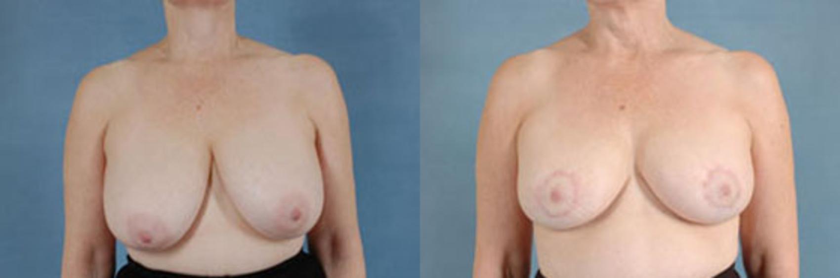 Before & After Breast Reduction Case 178 View #1 View in Tallahassee, FL