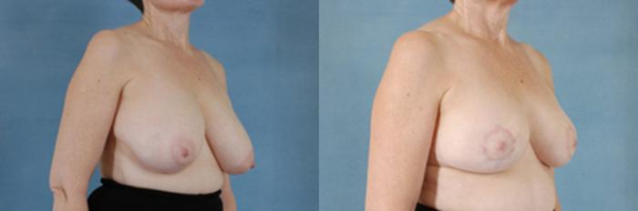Before & After Breast Reduction Case 178 View #2 View in Tallahassee, FL